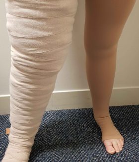 Compression bandaging and stocking